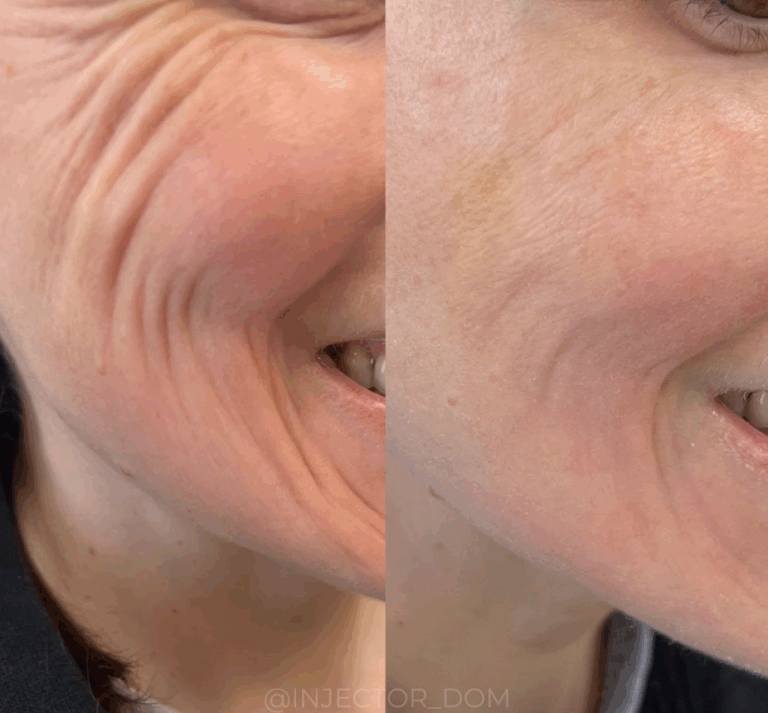 Botox in Chesapeake: Benefits, Results, and What to Expect