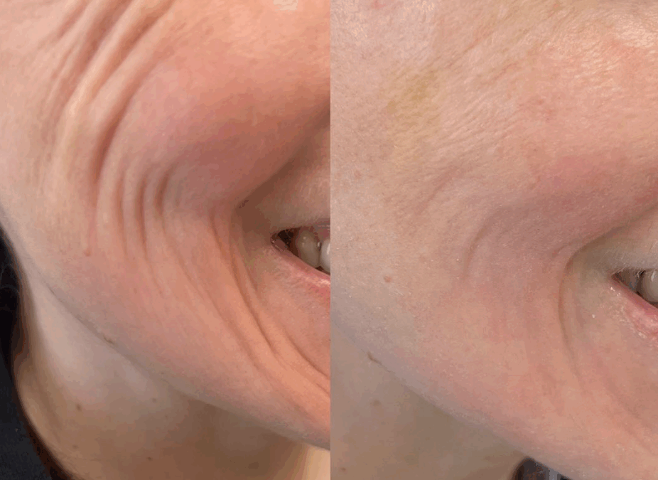 Botox in Chesapeake: Benefits, Results, and What to Expect