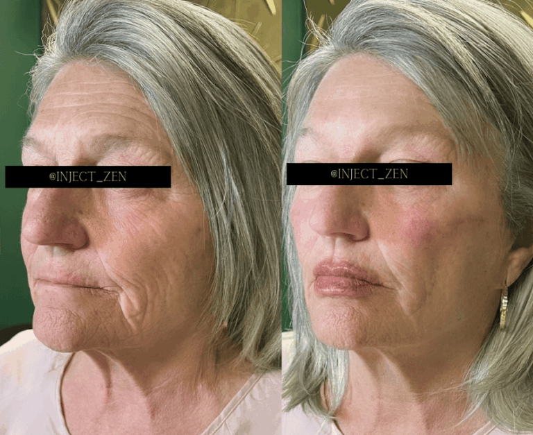 Botox and Fillers in Peabody: Achieve a Refreshed, Natural Look