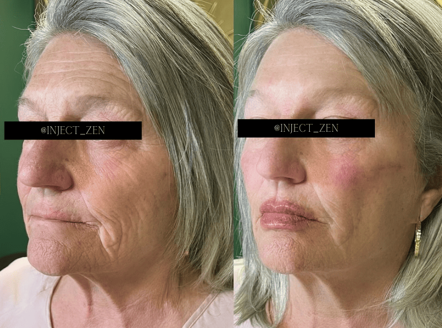 Botox and Fillers in Peabody: Achieve a Refreshed, Natural Look