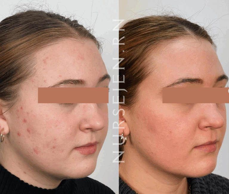 Microneedling Near Me — Why Peabody Residents Choose MD Esthetics