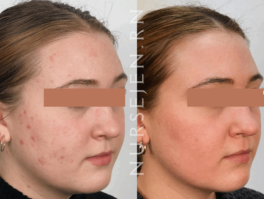 Microneedling Near Me — Why Peabody Residents Choose MD Esthetics