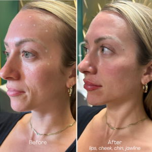 MD Esthetics, Before & After, Filler - lips, cheek, chin, jaw, Before and after results showcasing facial injectables that enhance definition