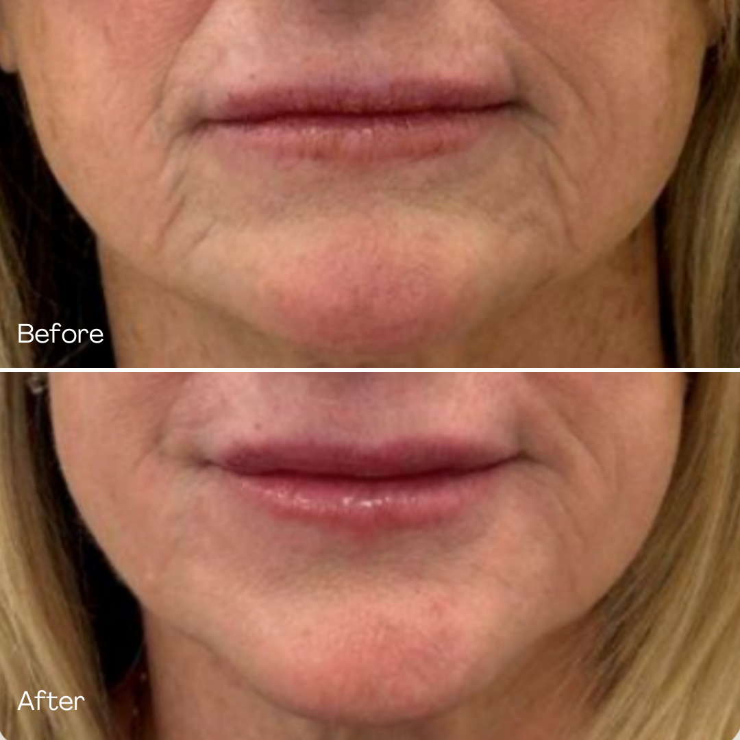 MD Esthetics, Before & After Sculptra, smooth out and restore volume to facial regions