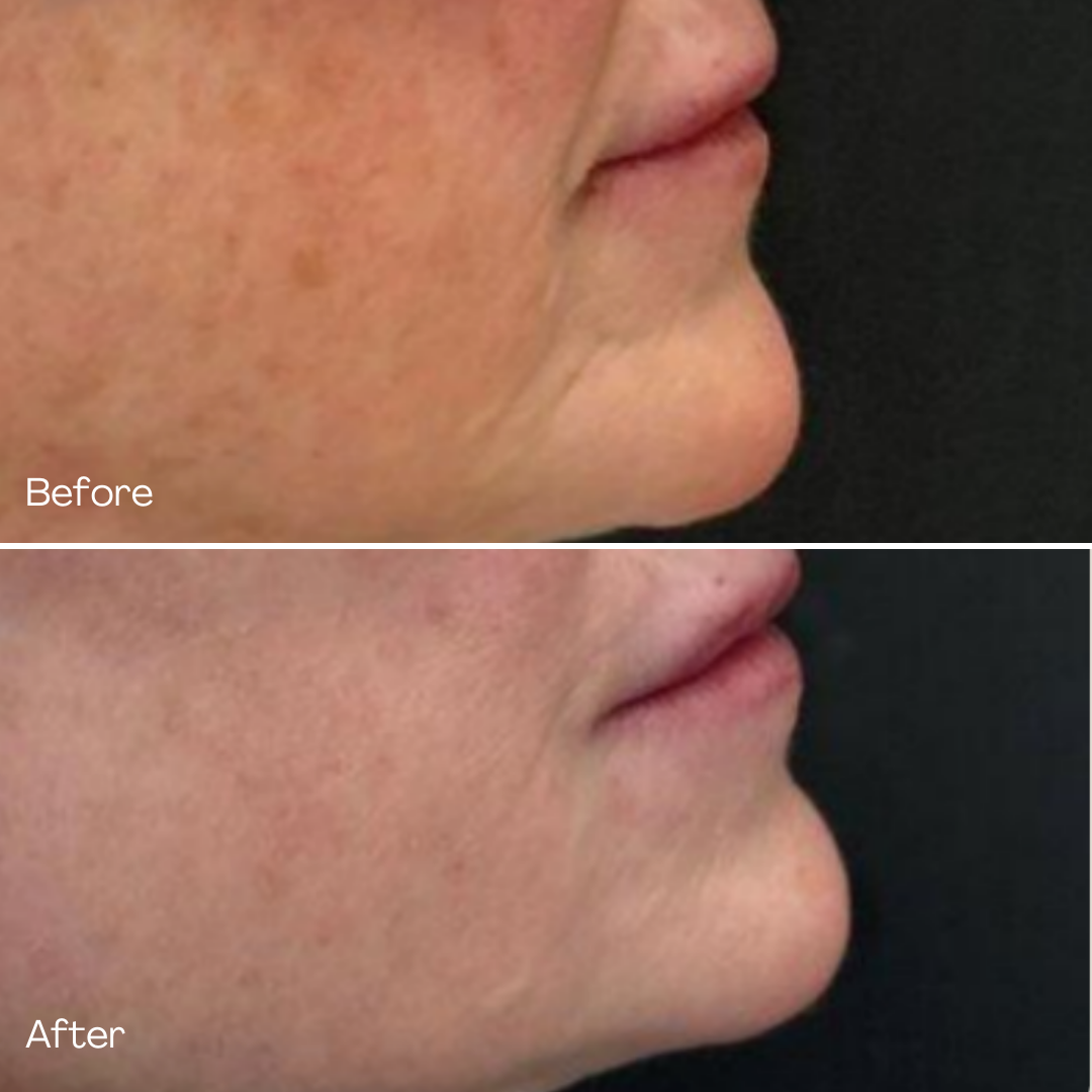 MD Esthetics, Before & After Sculptra, Sculptra is an injectable made with poly-L-lactic acid (PLL) technology