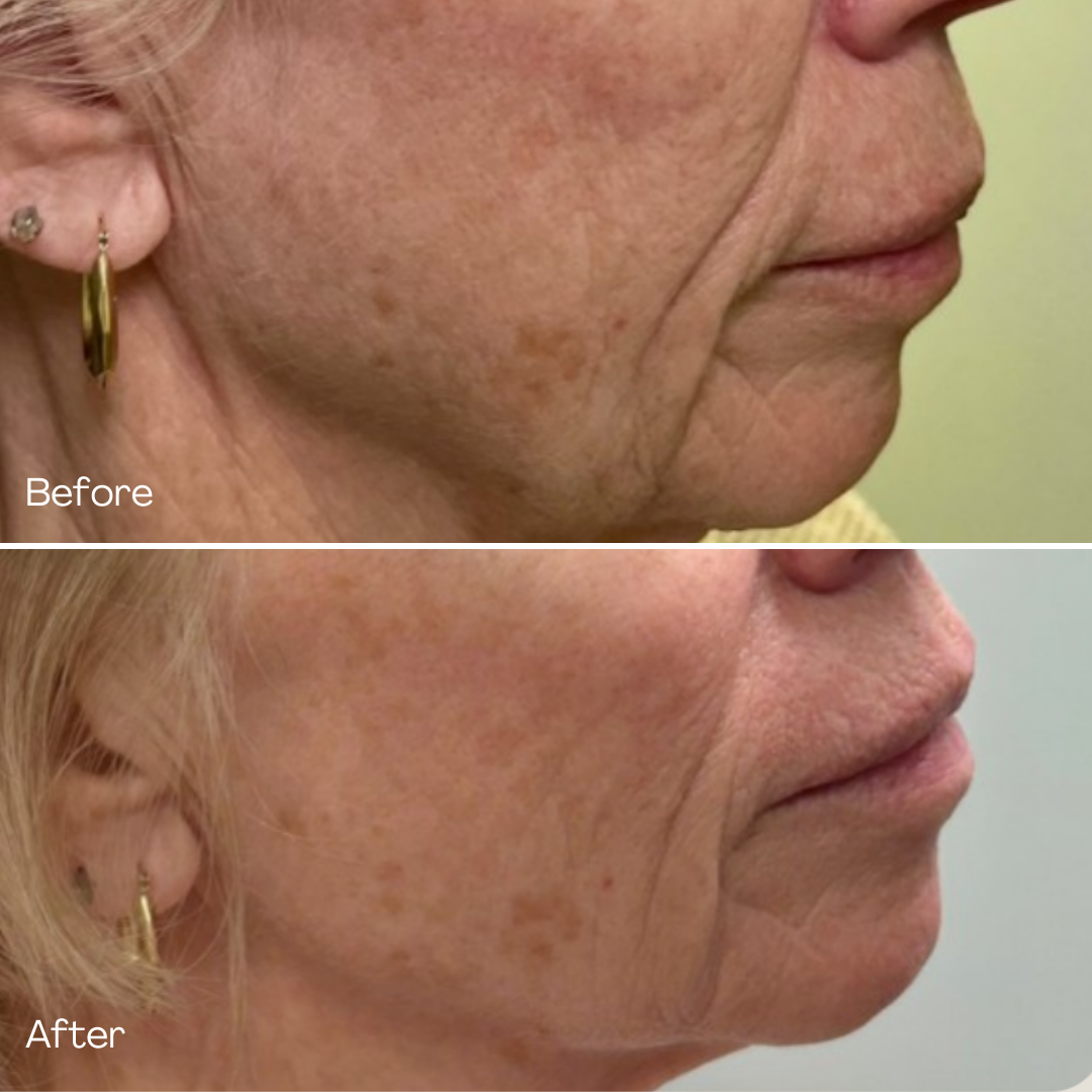 MD Esthetics, Before & After Sculptra, Revitalize Your Skin’s Collagen Production