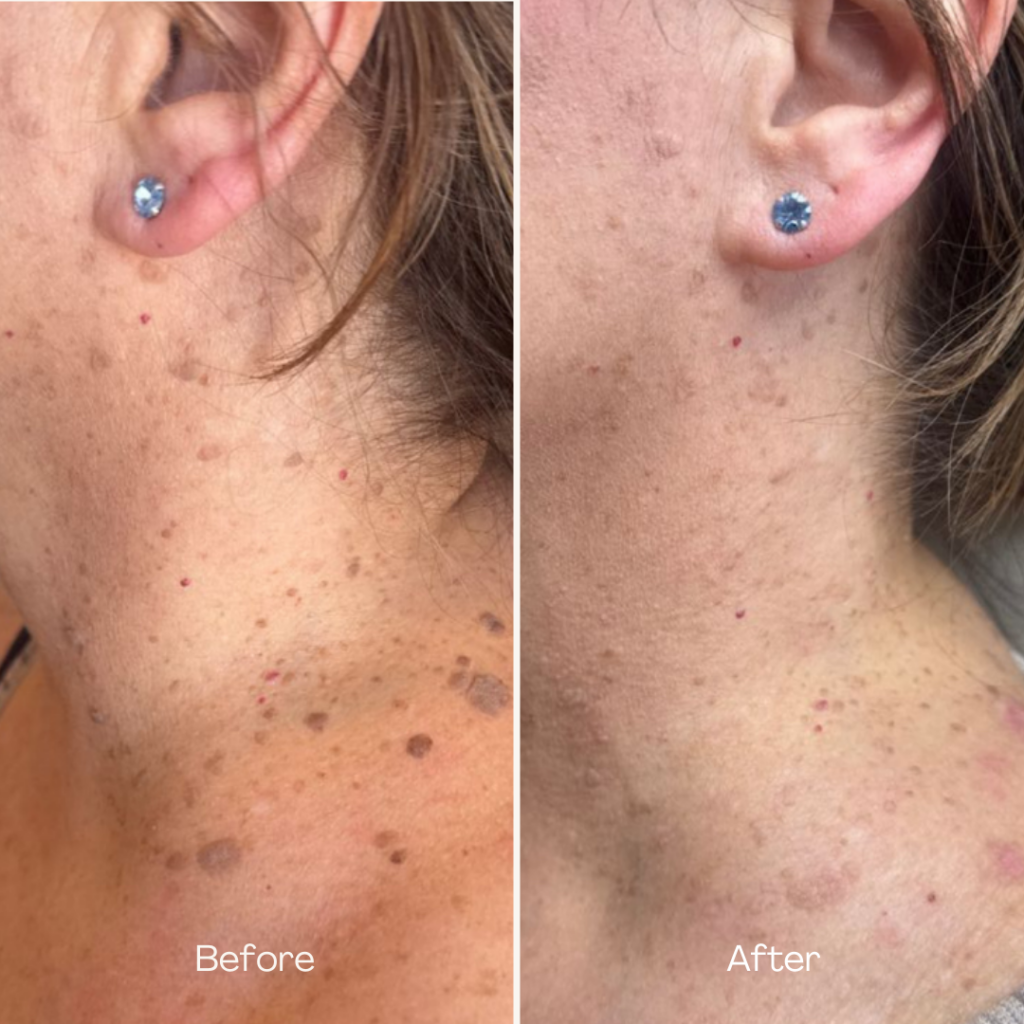 Before and after, patient 1