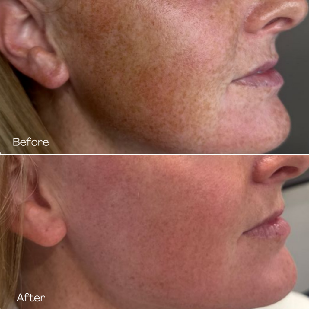 Before and after, patient 2