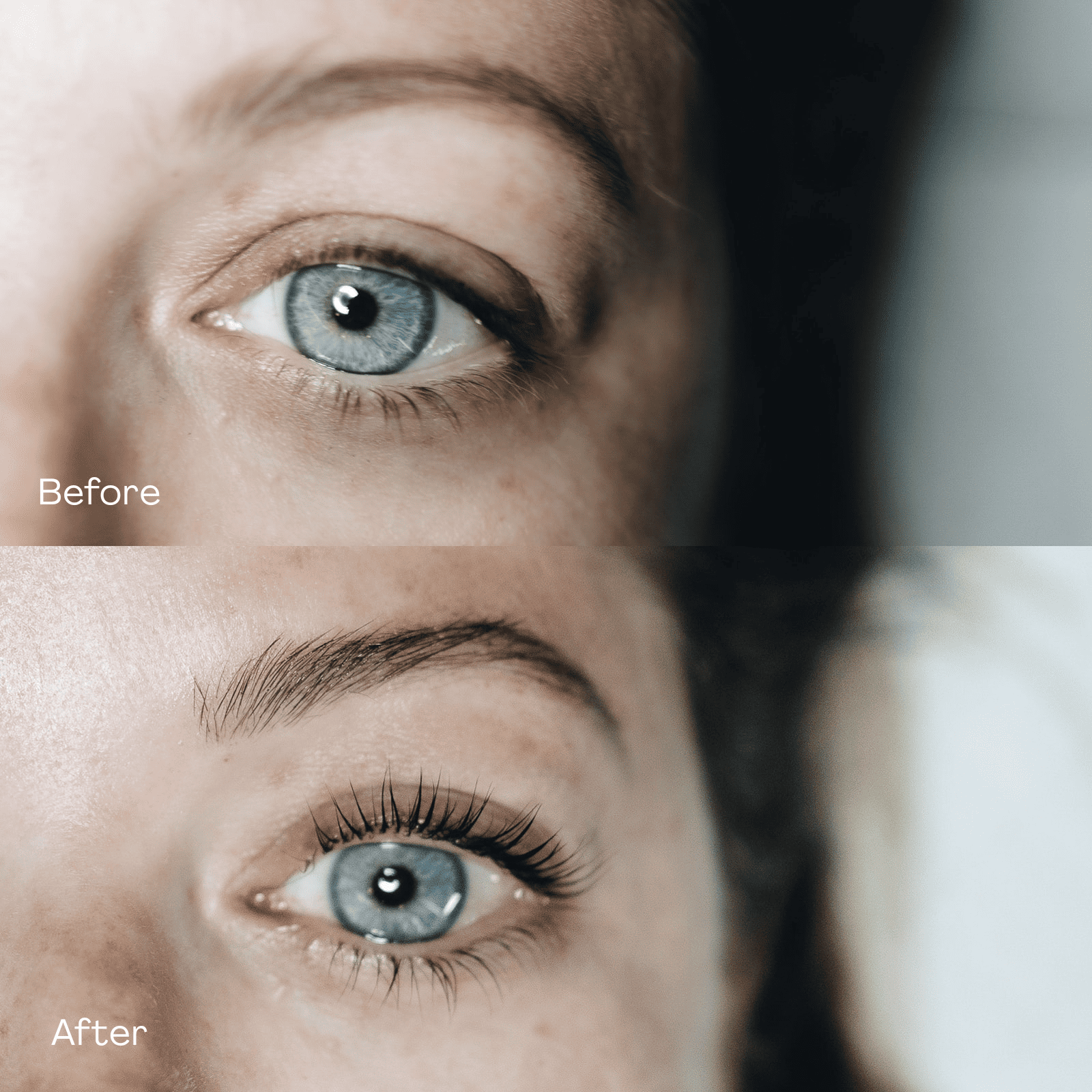 MD Esthetics, Before & After Sculptra, Revitalize Your Skin’s Collagen Production