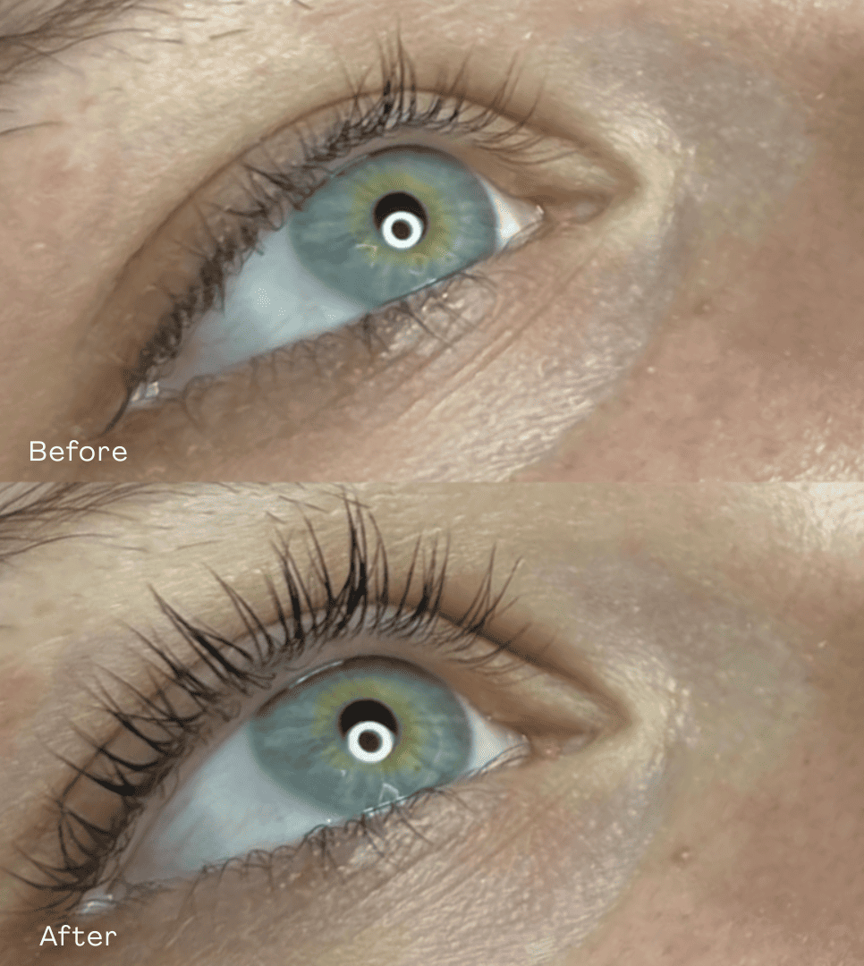 MD Esthetics, Before & After Sculptra, Revitalize Your Skin’s Collagen Production