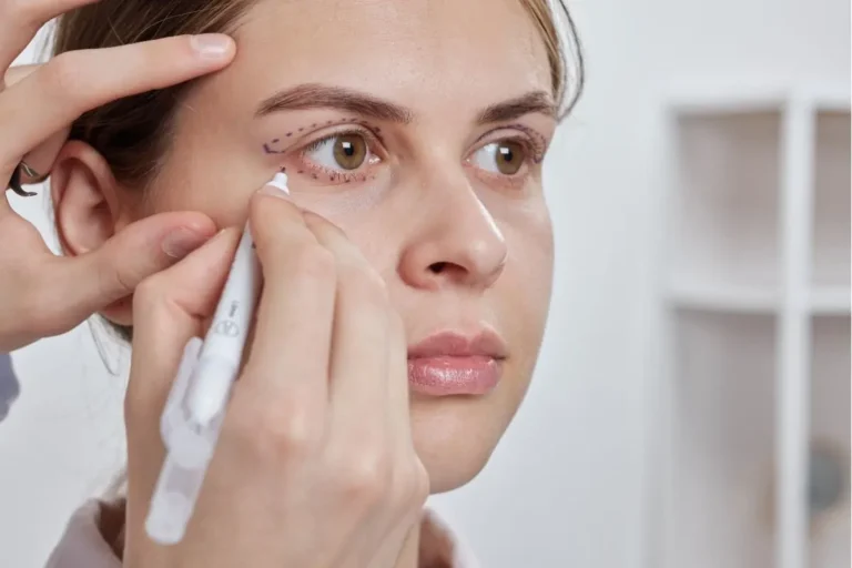 Filler migration assessment showing clinician marking facial areas for correction.