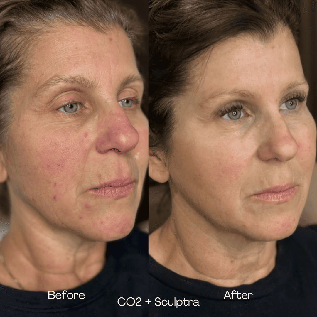 CO2 and Sculptra before and after — case 1