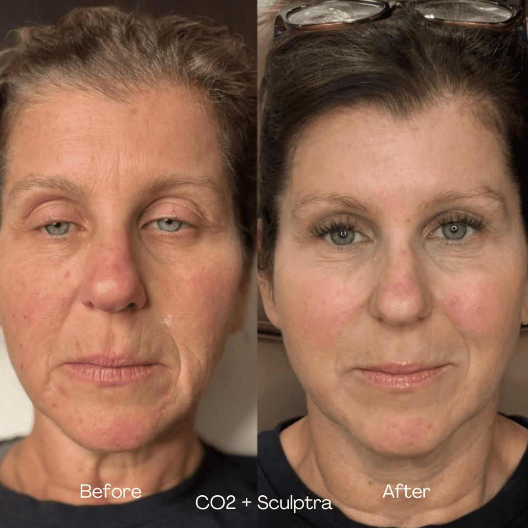 CO2 and Sculptra before and after — case 2