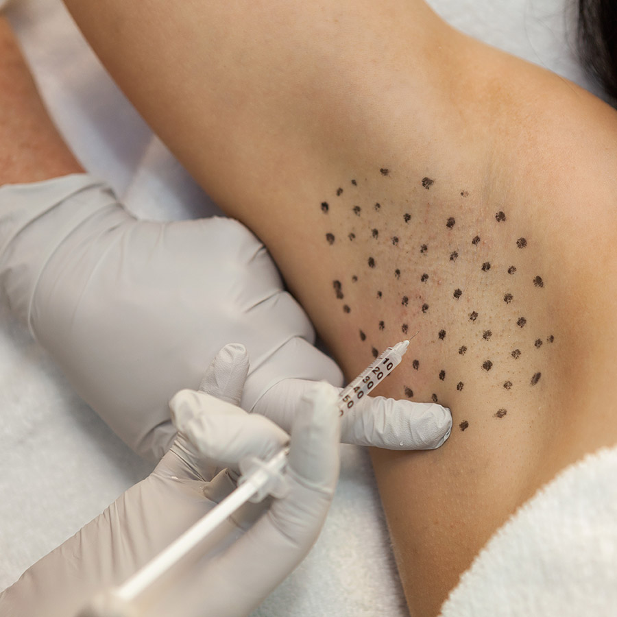 Underarm mapped with a grid of injection points before Botox for sweating is administered.