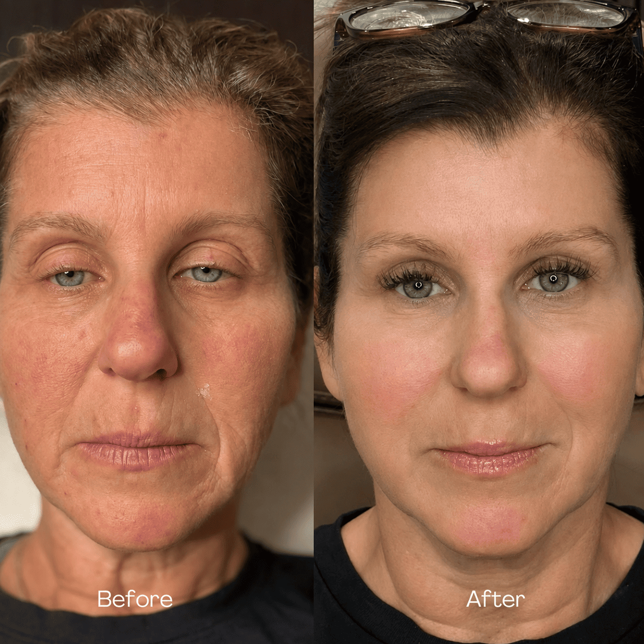 CO2 and Sculptra before and after — case 1
