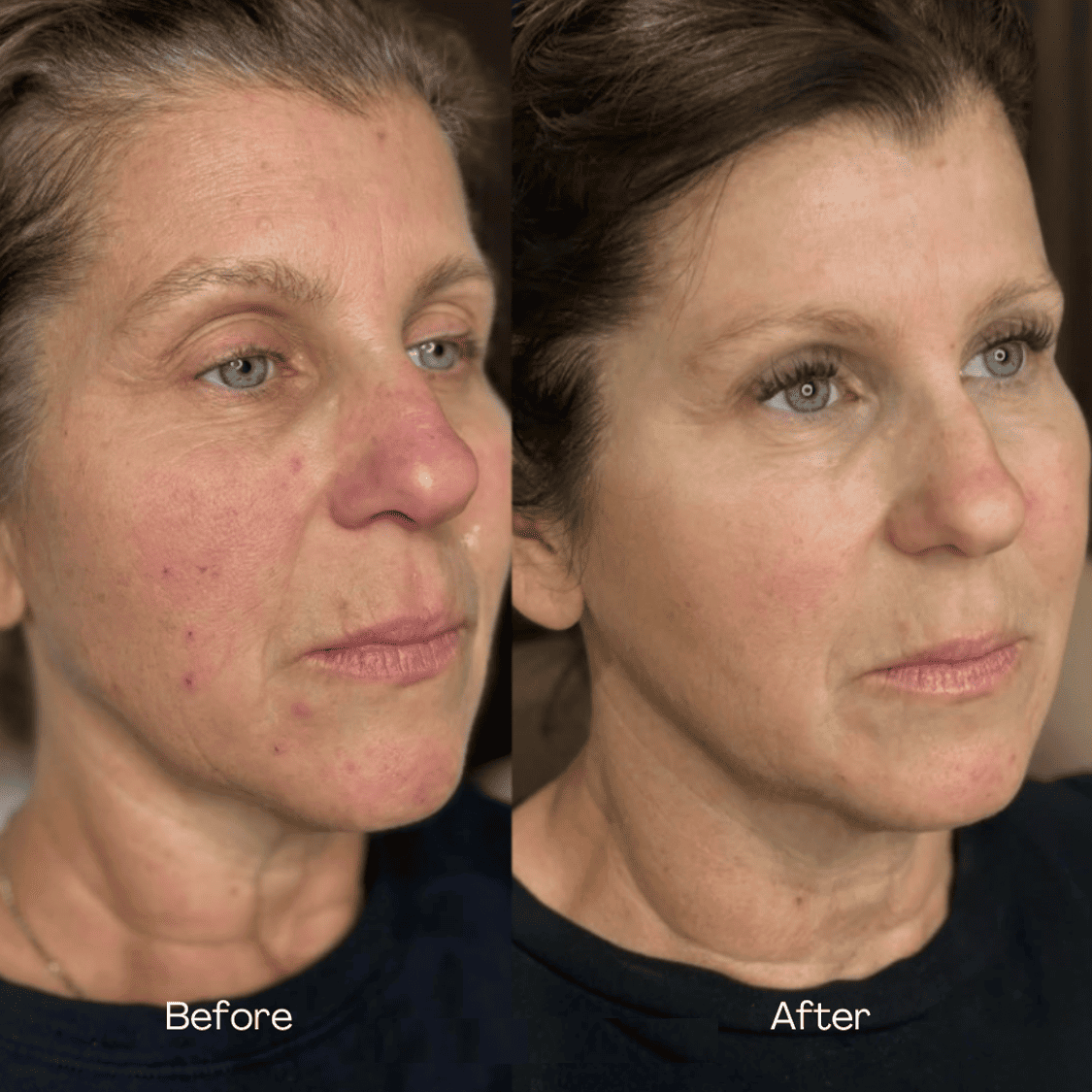CO2 and Sculptra before and after — case 2