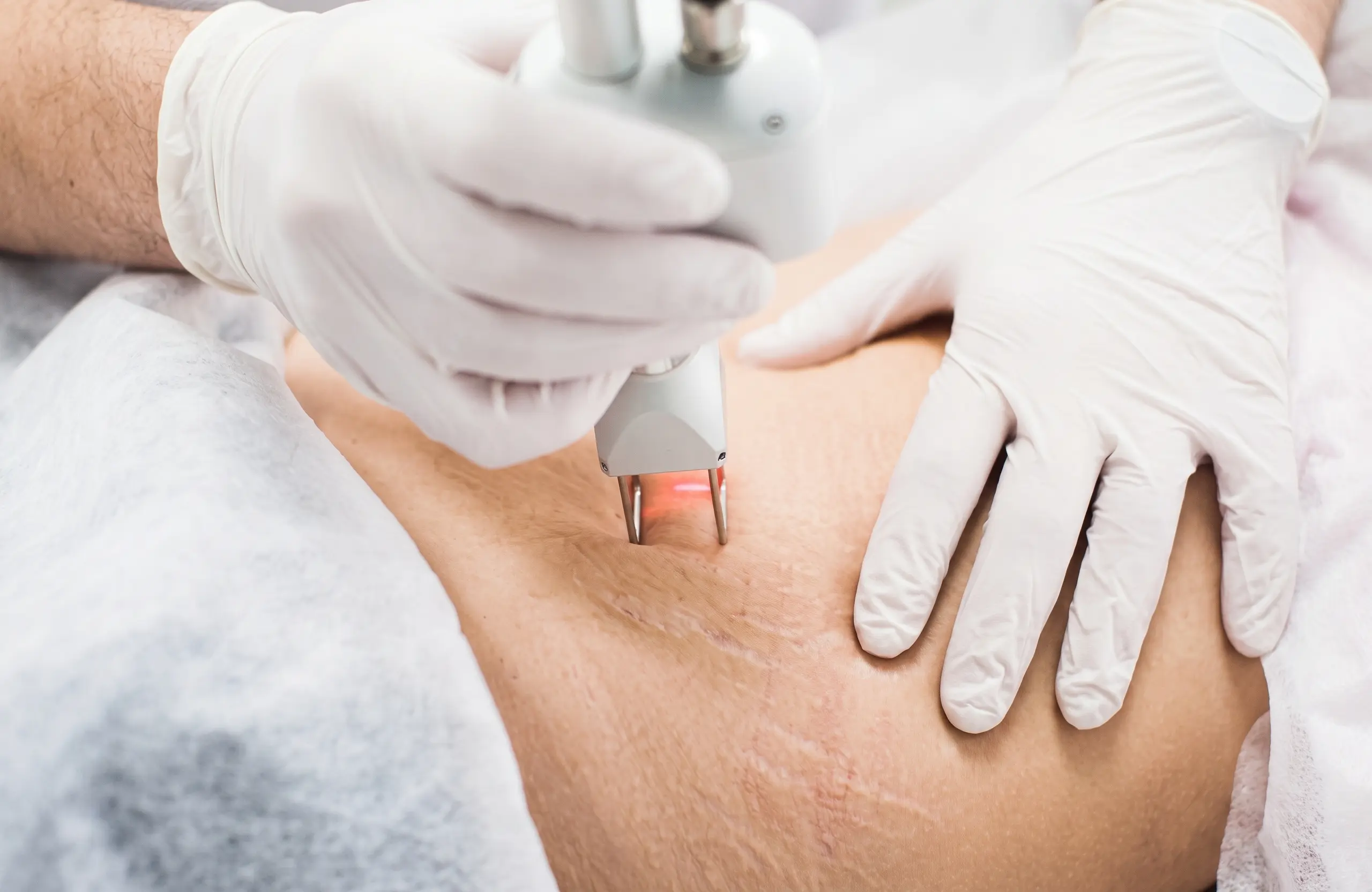Laser handpiece treating visible stretch marks on the abdomen at MD Esthetics.