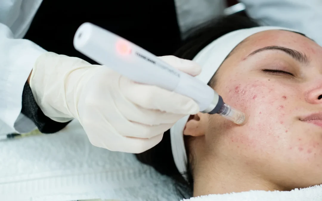 Acne Scar Laser Treatment: What Works | MD Esthetics