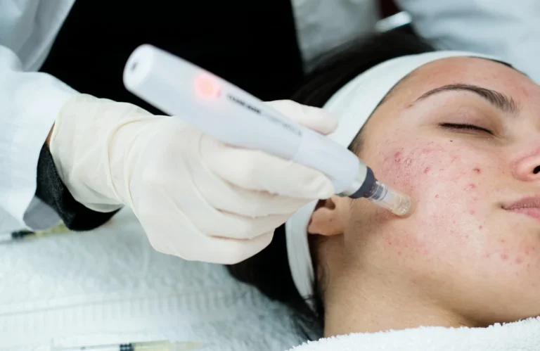 Acne Scar Laser Treatment What Works MD Esthetics.