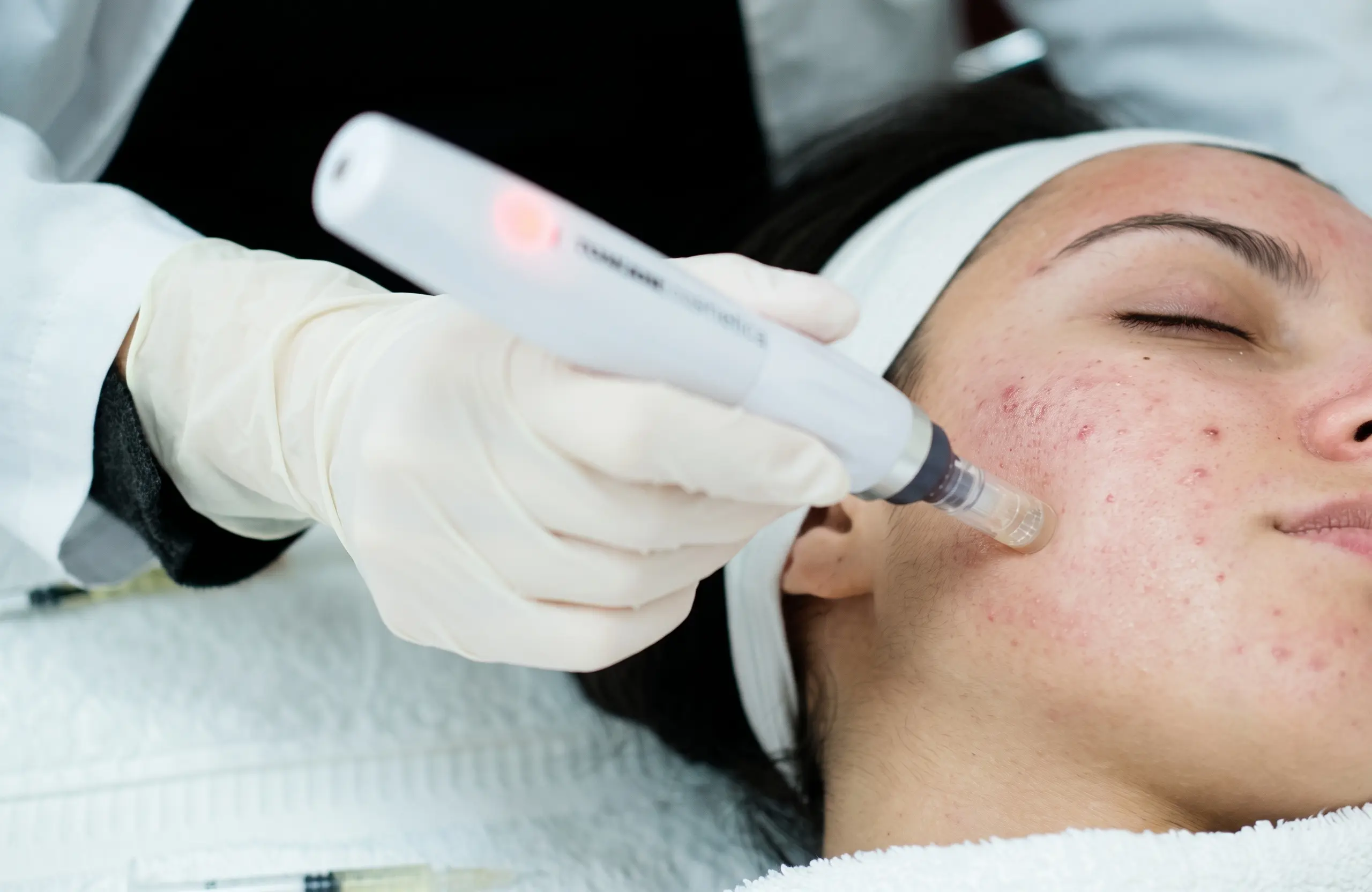 Microneedling pen being used on skin with active acne at MD Esthetics.