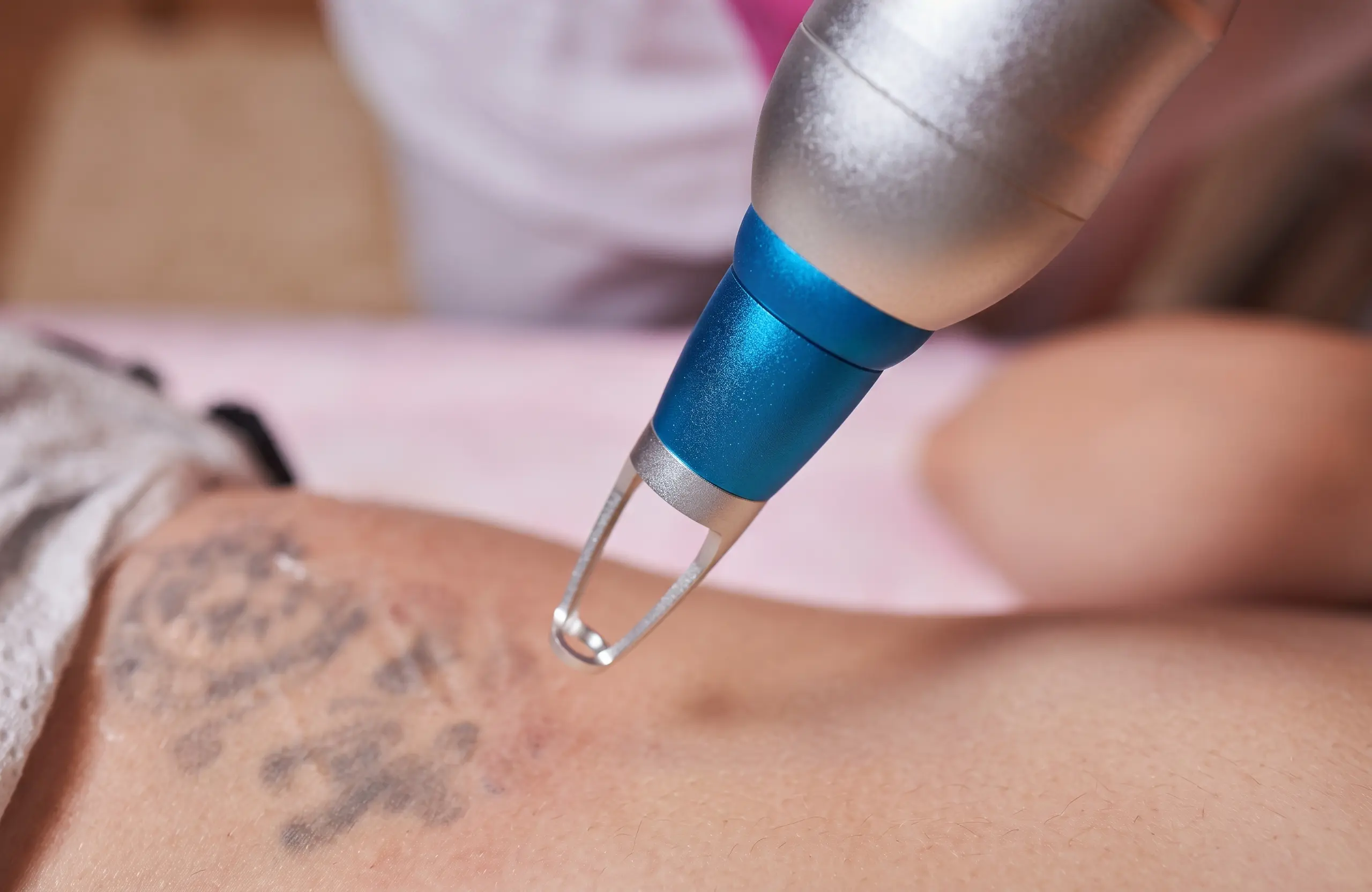 Laser handpiece passing over a faded blue and black arm tattoo during removal.
