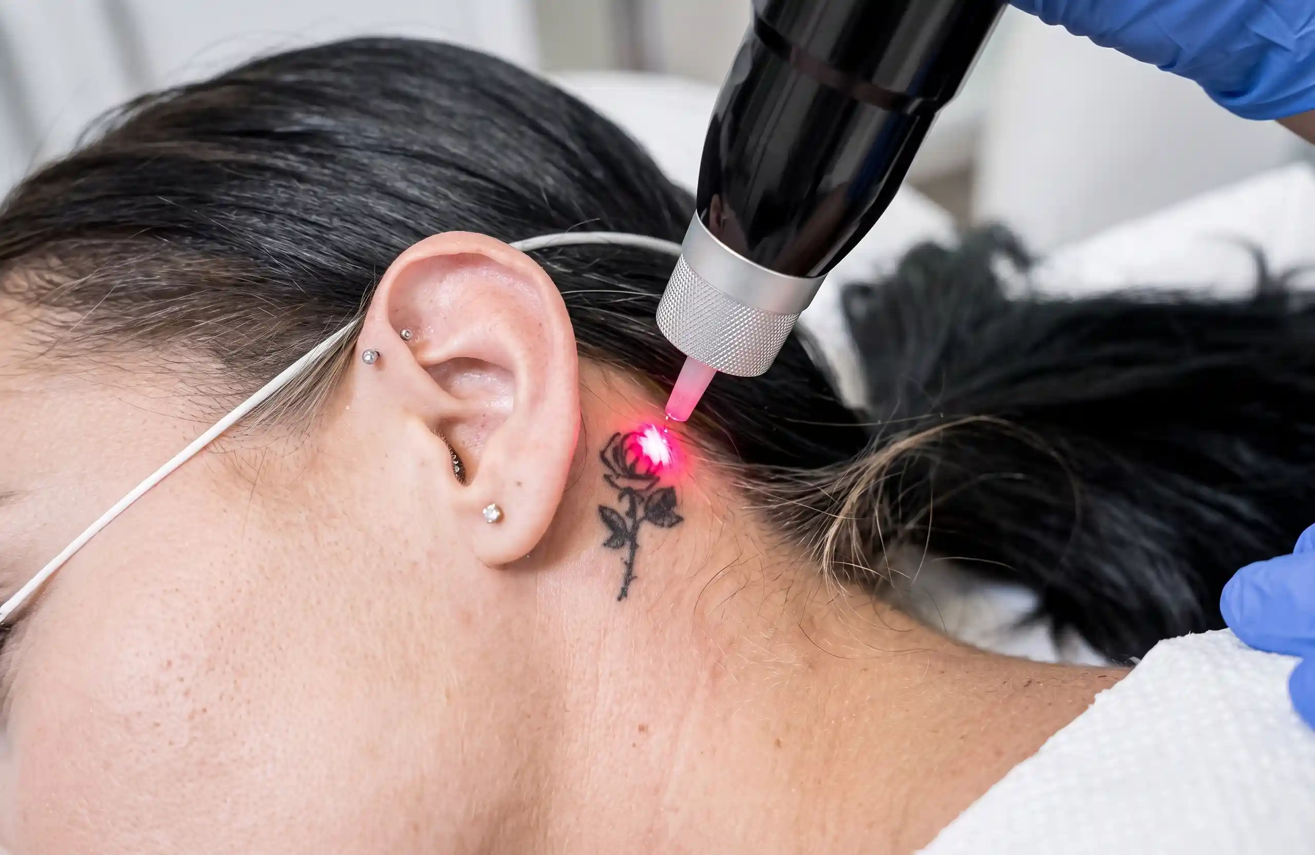 Laser pulse over a small rose tattoo behind the ear during a tattoo removal session.