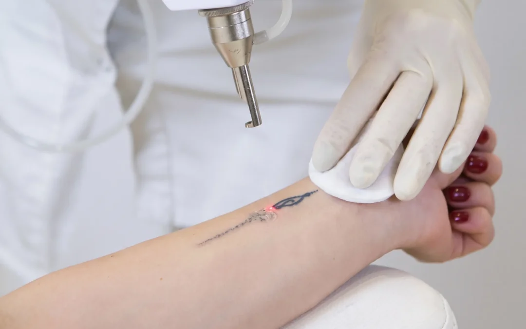 Laser Tattoo Removal Cost: What Drives It | MD Esthetics
