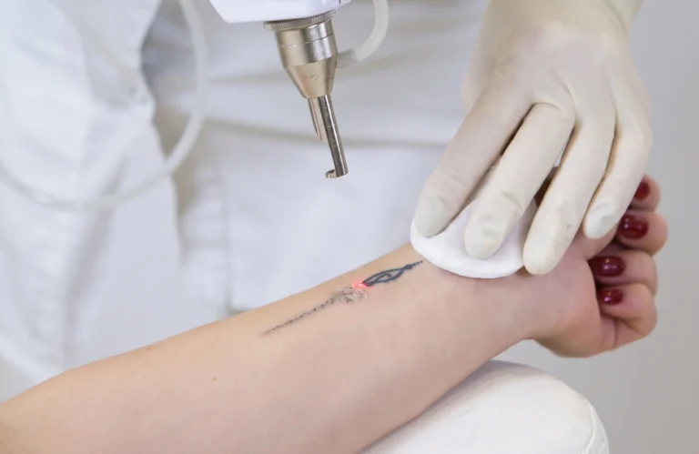 Laser Tattoo Removal Cost What Drives It.